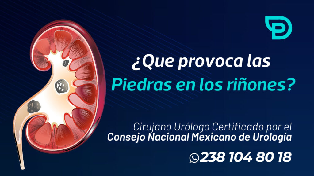 Que provoca las piedras en los riñones - Urología Tehuacán